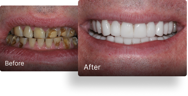 Before and after dental implant treatment 7