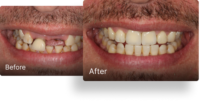 Before and after dental implant treatment 4