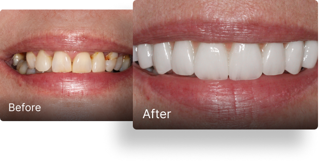 Before and after dental implant treatment 6