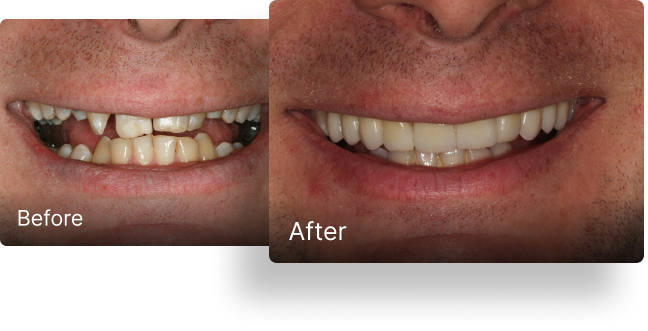 Before and after dental implant treatment 1