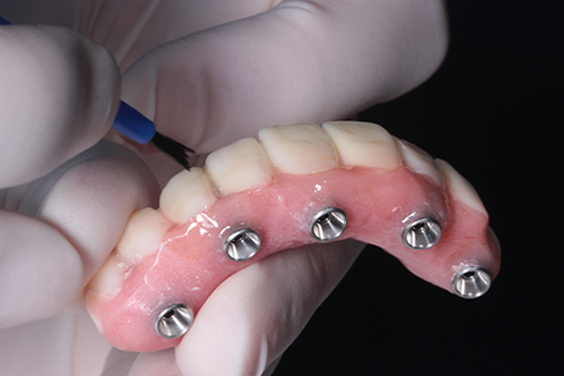 All-on-4 & Same Day Teeth