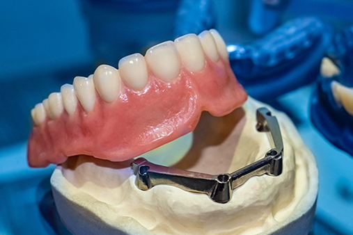 Implant-Retained Dentures