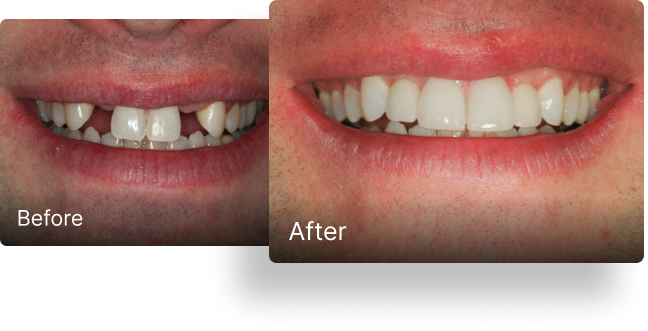Before and after dental implant treatment 3