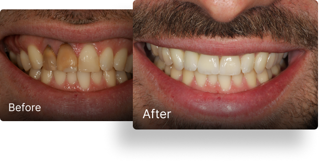 Before and after dental implant treatment 5