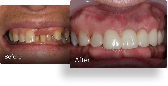 Before and after dental implant treatment 2